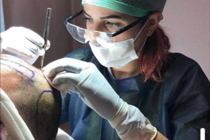 زراعة الشعر بدون حلاقة حصرياً في مركز Estepera