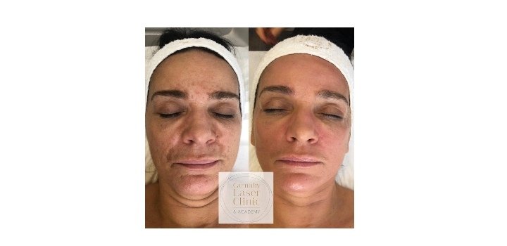 مركز “The Carnaby Laser Clinic” في لندن إسم رائد في مجال العلاج بالليزر