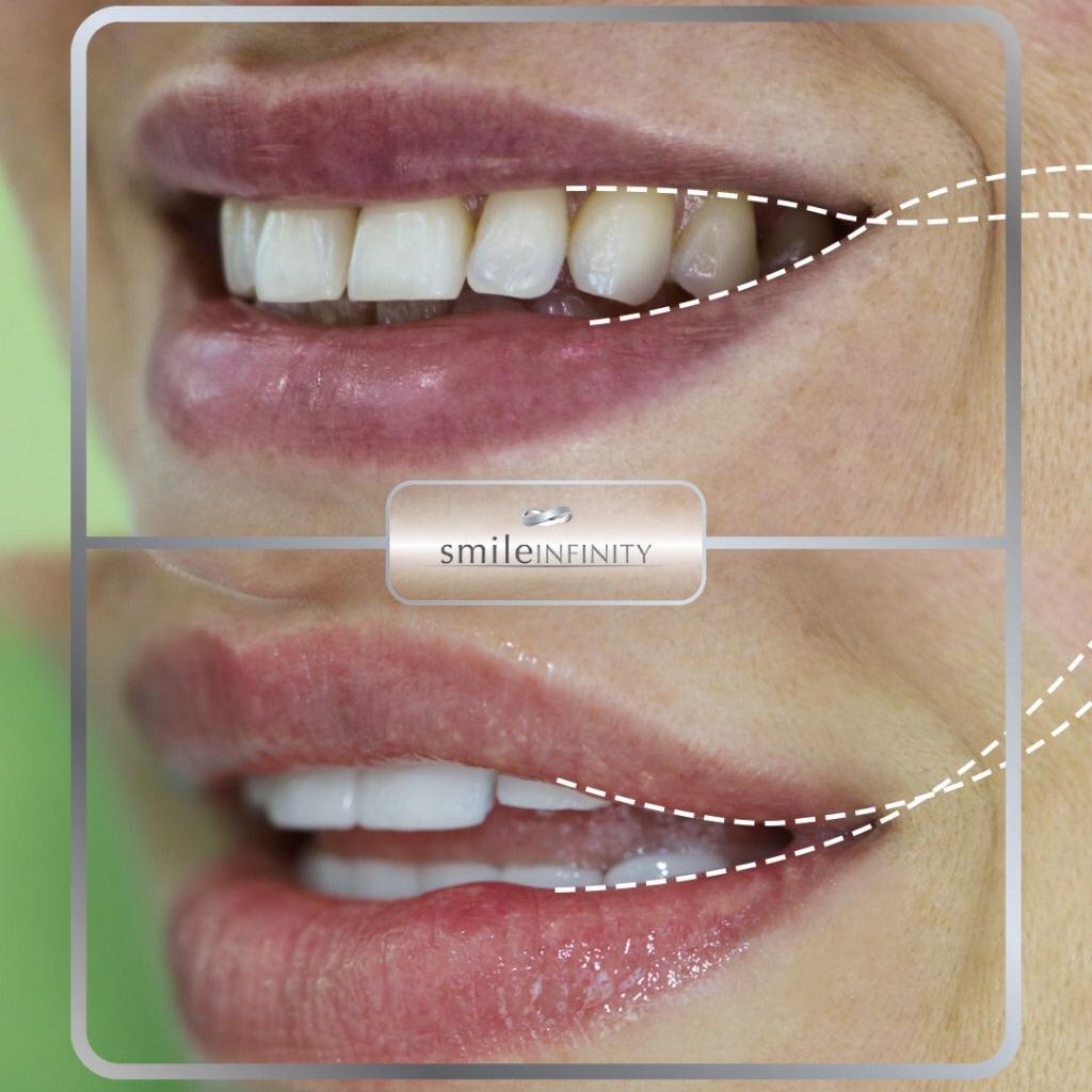 الدكتور حبيب ظريفه يبتكر تقنية جديدة لمحاربة الشيخوخة و تجميل الأسنان “Smile Lift”