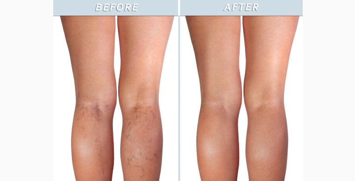 العيادة الطبية التجميلية “Carnaby Laser Clinic and Academy” تساعد المرضى على التخلص من الأوردة العنكبوتية دون جراحة