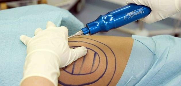 دكتور التجميل اللبناني علي عبد علي يتطرّق الى عملية شفط الدهون