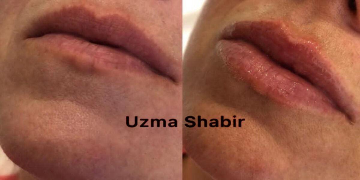 خبيرة التجميل عظمي شبير/ Uzma Shbr خبيرة في مجال حقن الفيلر