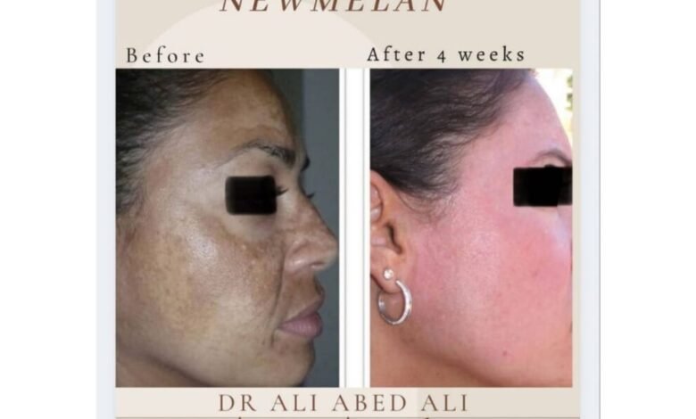 دكتور التجميل “ali abedali” و تقنية “newmelan pigmentation”